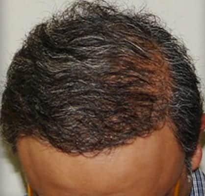 After Treatment for Severe Male Baldness - Dr U Hair and Skin Clinic