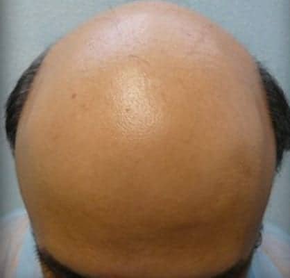 Severe Male Baldness - Dr U Hair and Skin Clinic