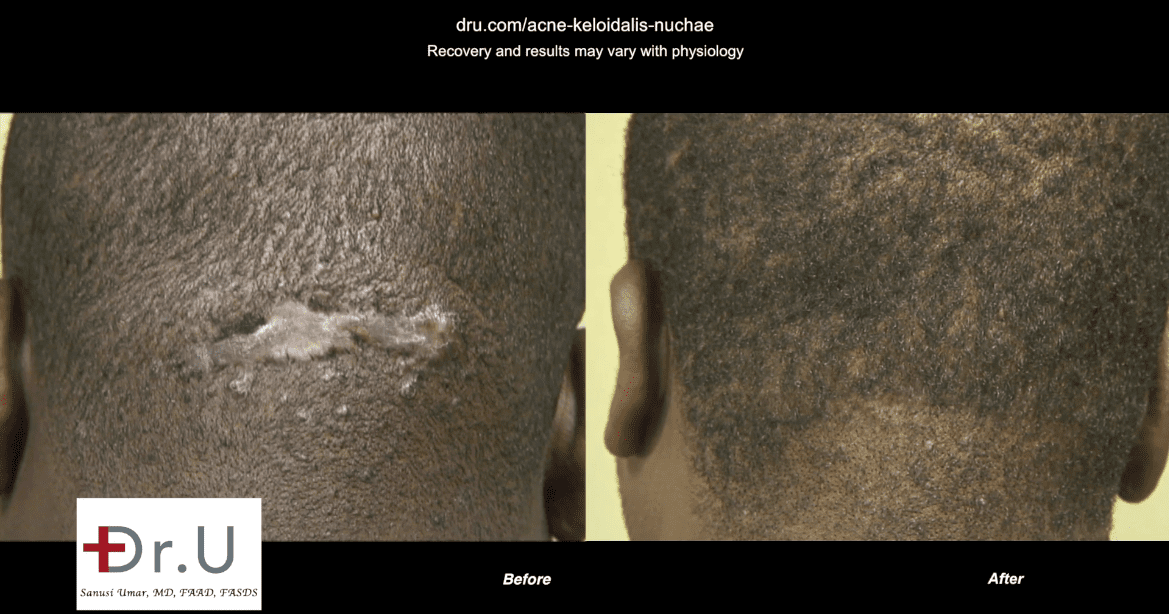Video Surgical Removal Of Akn Lump On Back Of The Head By Dr U